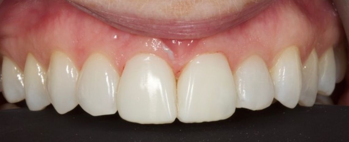 Before & After (Dr Sherry Mowla) Composite Bonding & Whitening  After
