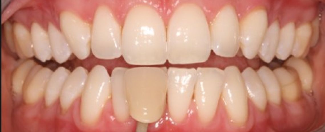 Before & After (Dr Sherry Mowla) Whitening  After