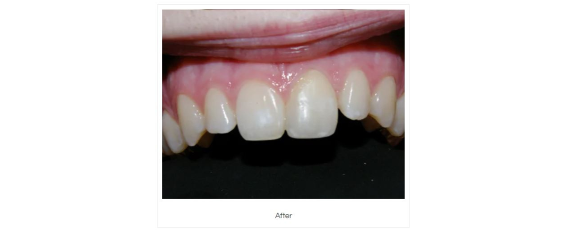  Tooth repair using composite fillings After
