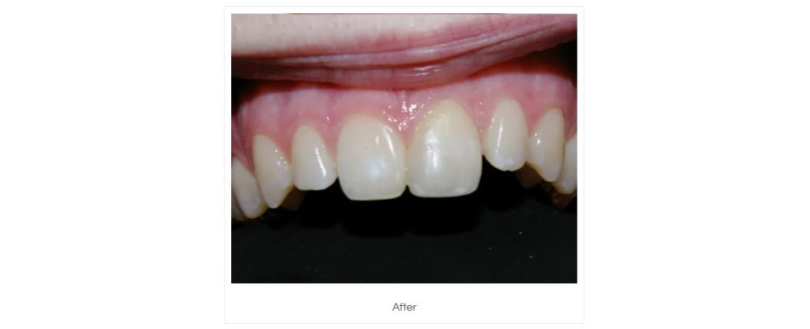 Tooth repair using composite fillings After