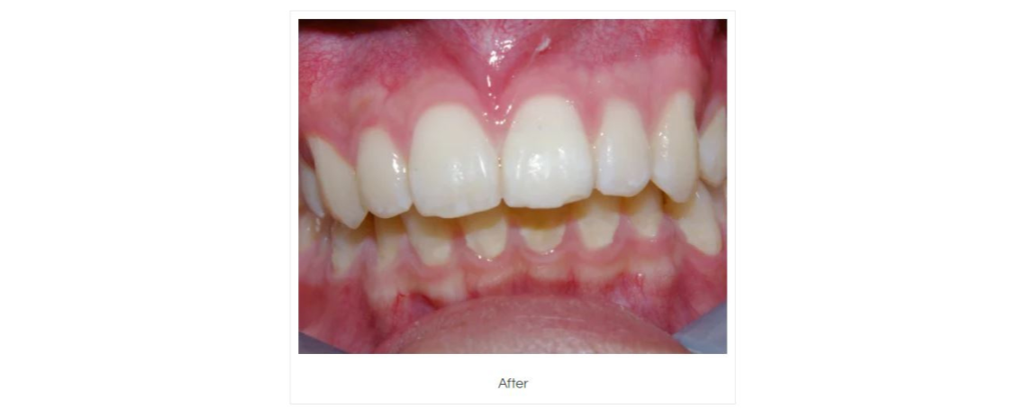 Fractured Tooth Repair After