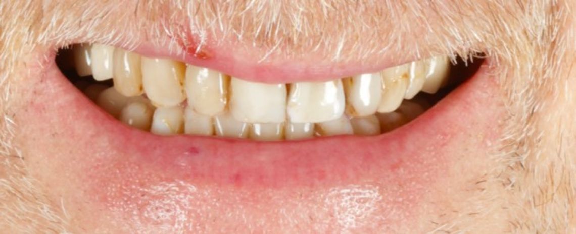 Before & After (Dr Sherry Mowla) Composite Bonding  Before